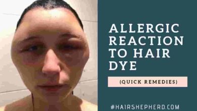 Allergic reaction to hair dye