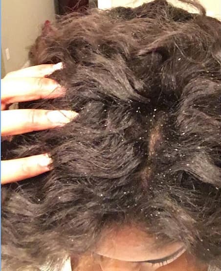 Itchy Scalp Build-Ups